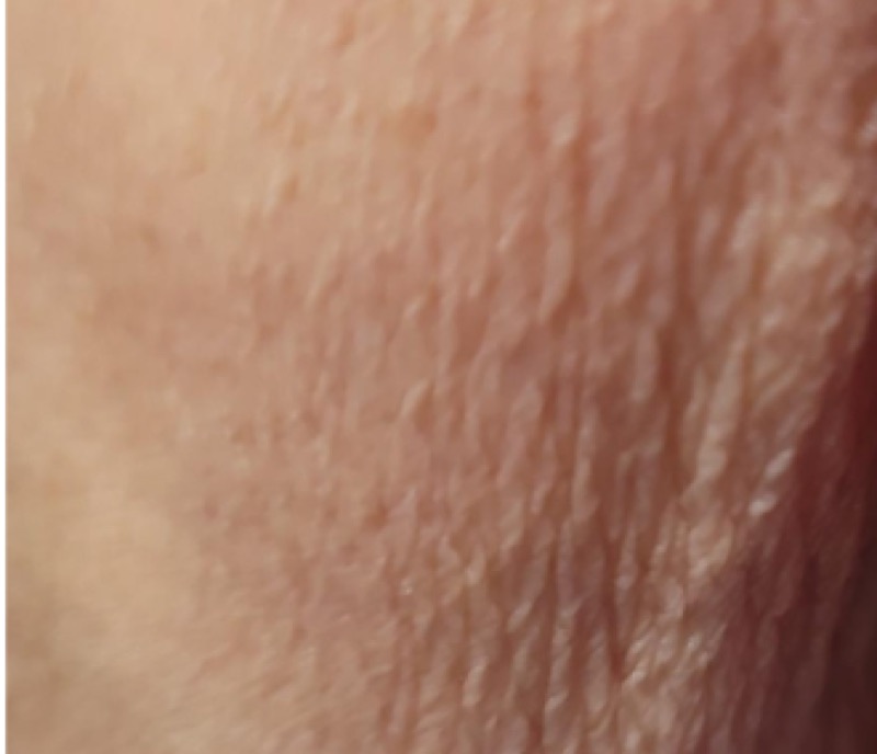 Arm after Morpheus8 crepey skin treatment