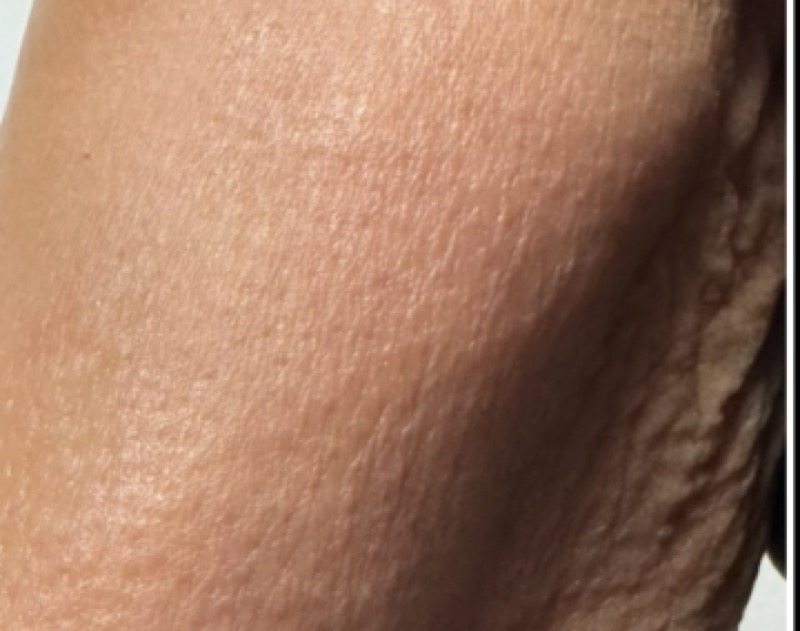 Arm before Morpheus8 crepey skin treatment