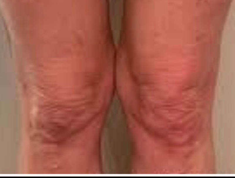 Knees after Morpheus8