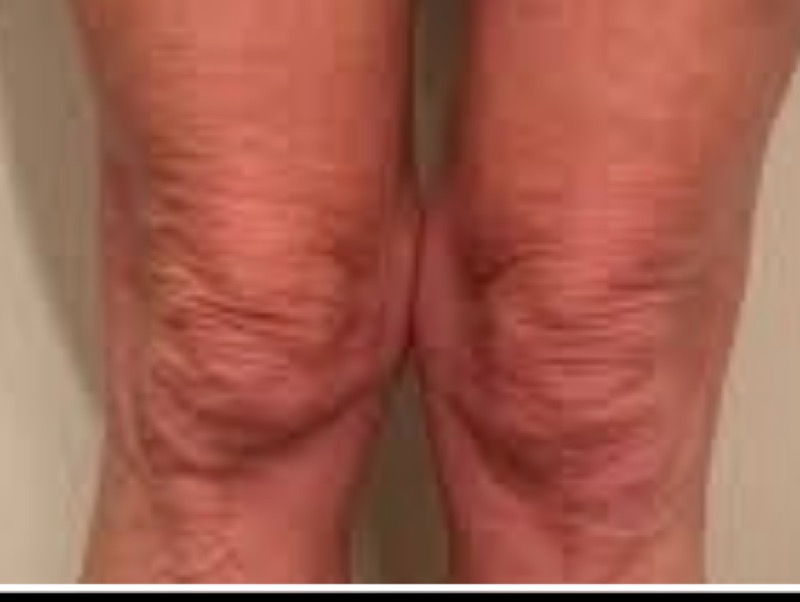 Knees before Morpheus8
