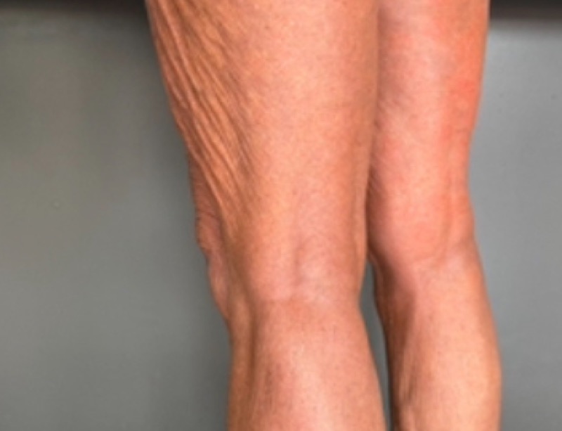 Legs after Morpheus8 resurfacing