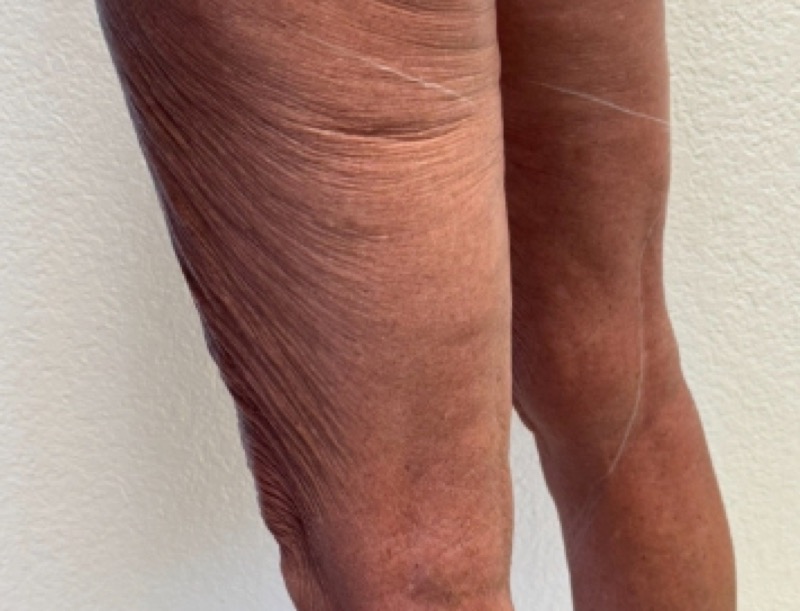 Legs before Morpheus8 resurfacing