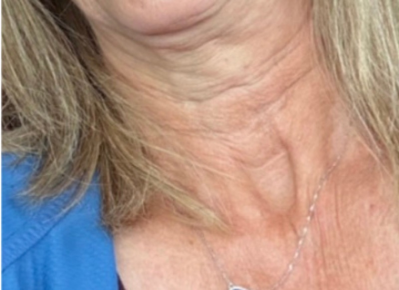 Neck after Morpheus8 fine line treatment