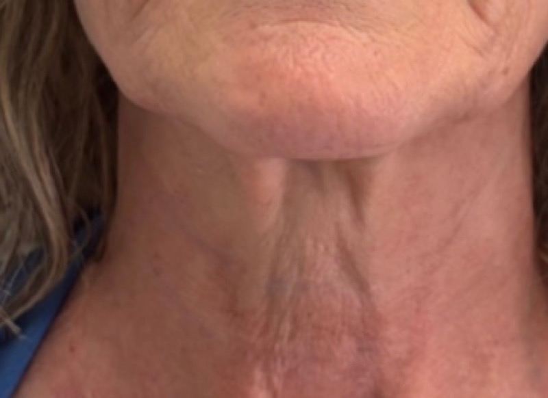 Neck before Morpheus8 fine line treatment
