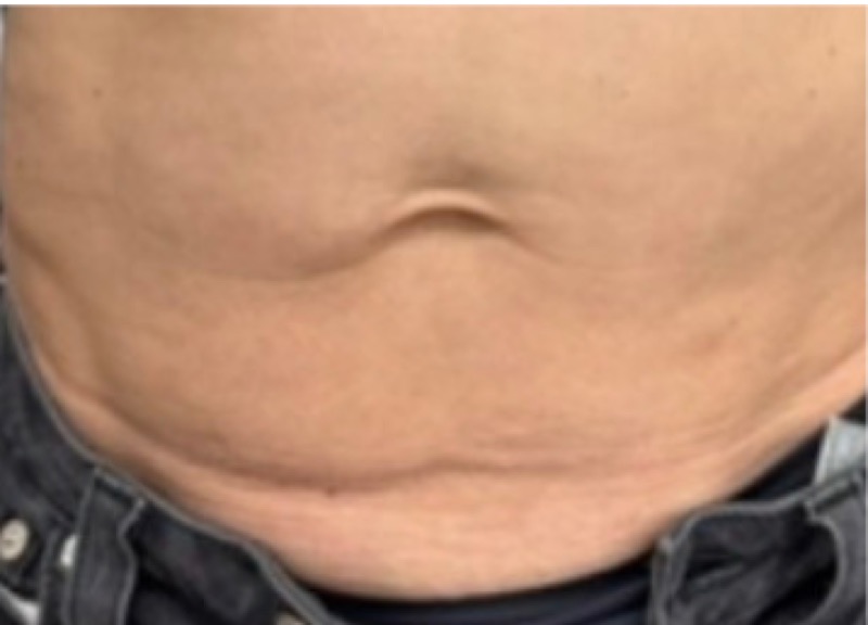 Stomach after Morpheus8 skin tightening