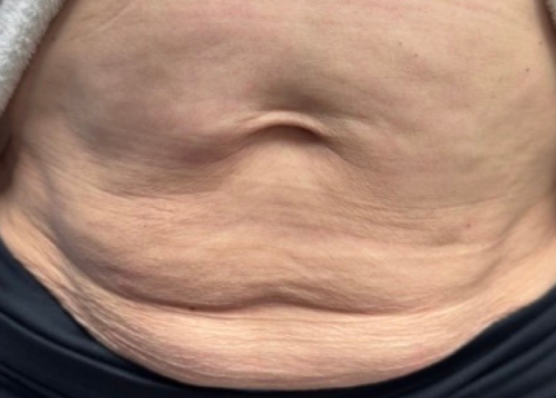 Stomach before Morpheus8 skin tightening